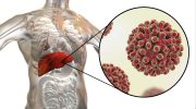 Virus hepatitidy A napadající játra – prevence hepatitidy A jako klíč k ochraně zdraví