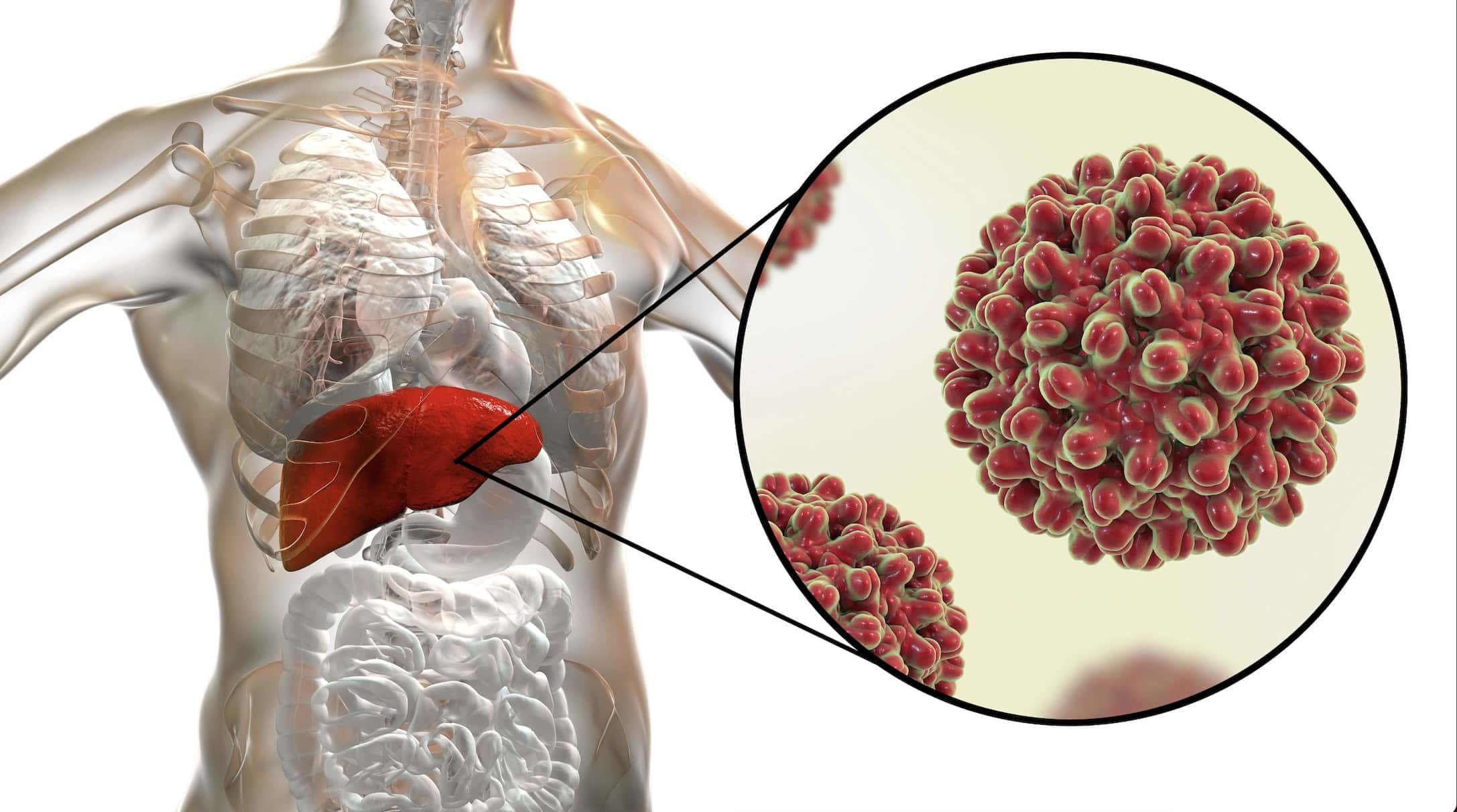 Virus hepatitidy A napadající játra – prevence hepatitidy A jako klíč k ochraně zdraví